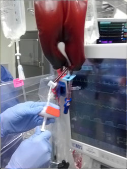 Blood transfusions do continue to have risks.