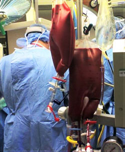 Can you limit the amount of blood loss & hemodilution and reverse it? The Hemobag® does both.
