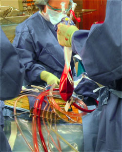 Presently, the only whole blood ultrafiltration device in clinical use is the Hemobag